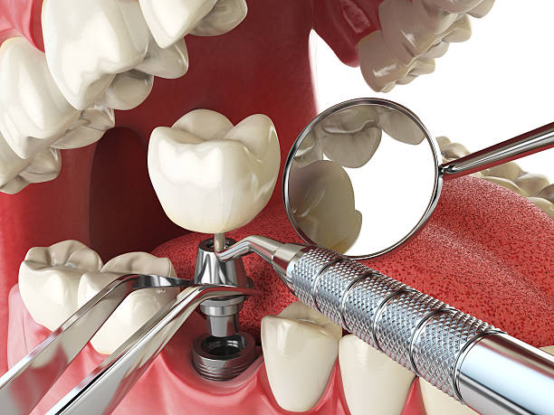 Best Emergency Dental Extractions in Erda, UT